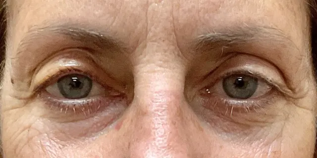 Close-up of a patient&rsquo;s eyes and upper eyelids
